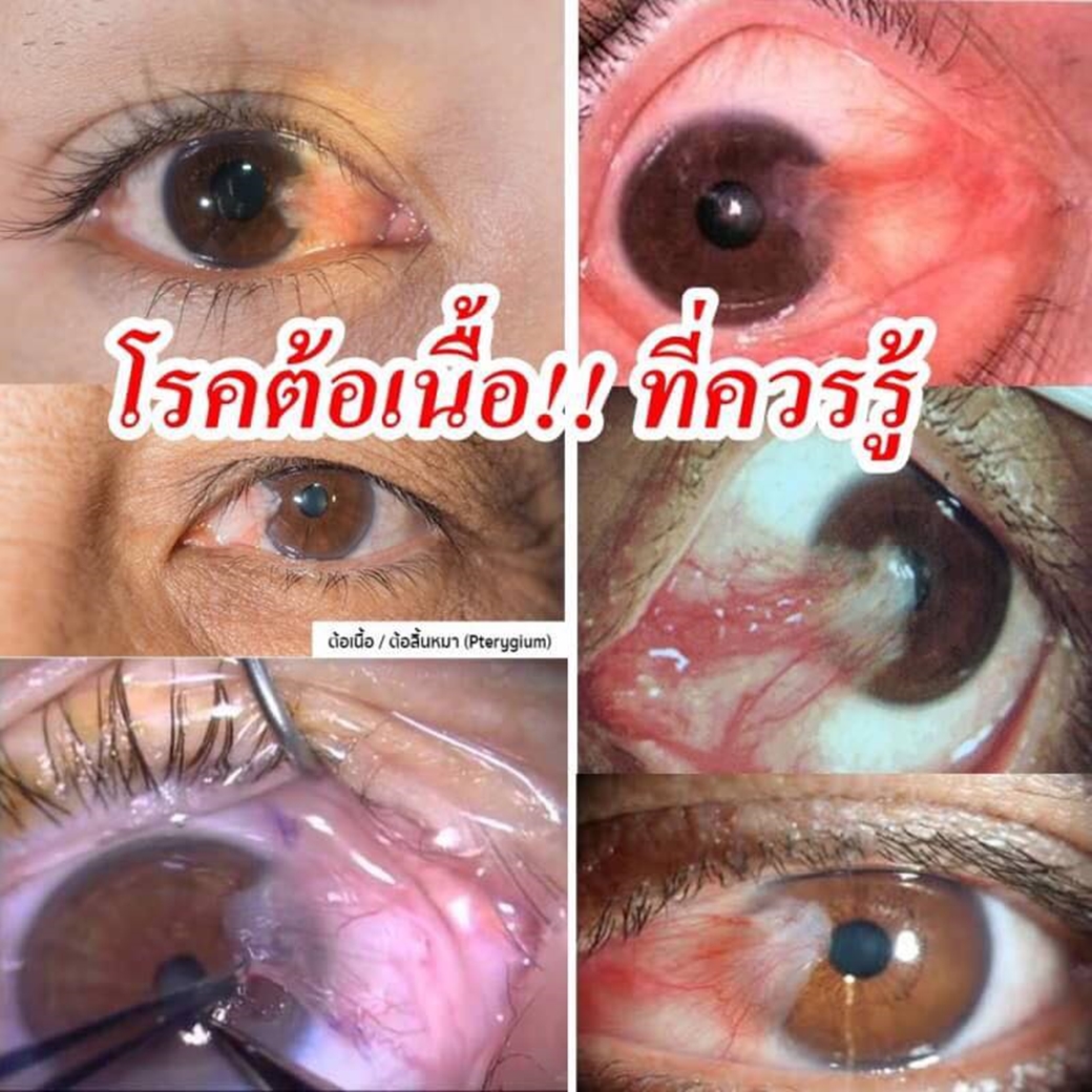 โรคต้อเนื้อ 