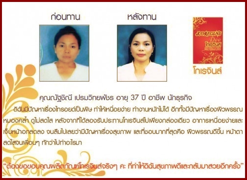 ไทรอยด์หายขาด