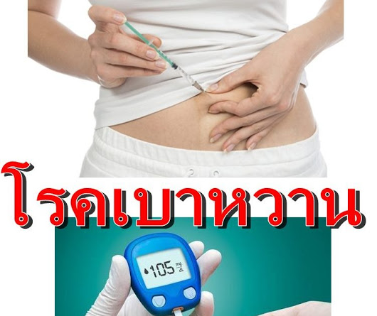 โรคเบาหวาน