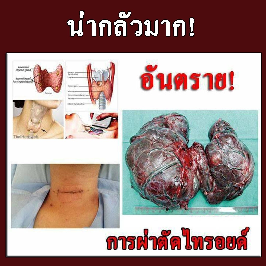 ไทรอยด์เป็นพิษ
